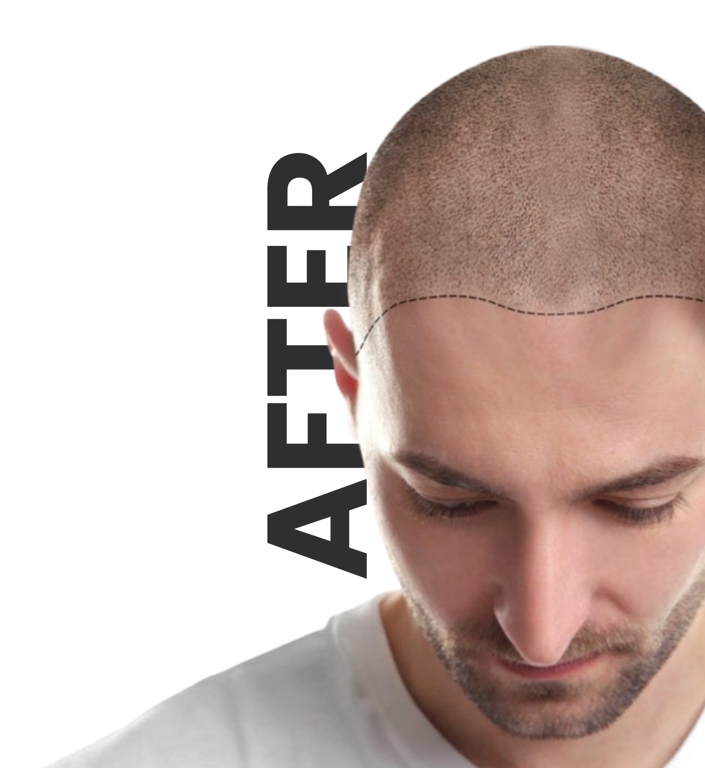 Before & After Photo Gallery Hair Transplant in Delhi | Hair Transplant  Cost in Delhi Clinic