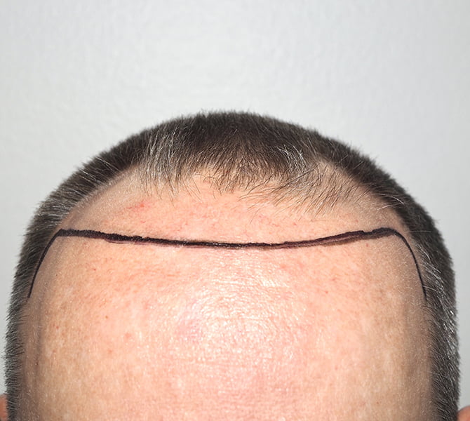 The Hair Transplant Center New Jersey FUE, FUT & More Hair