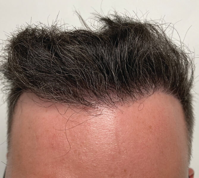 The Hair Transplant Center New Jersey FUE, FUT & More Hair