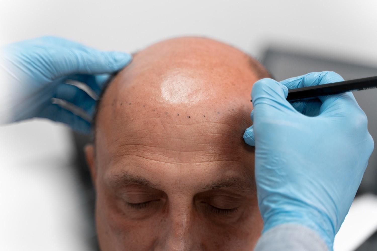 graft recovery timeline after procedure