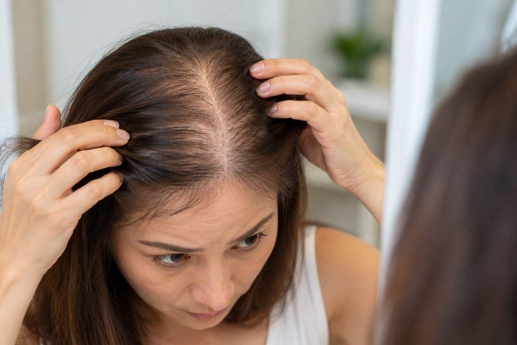 female pattern hair loss and shedding