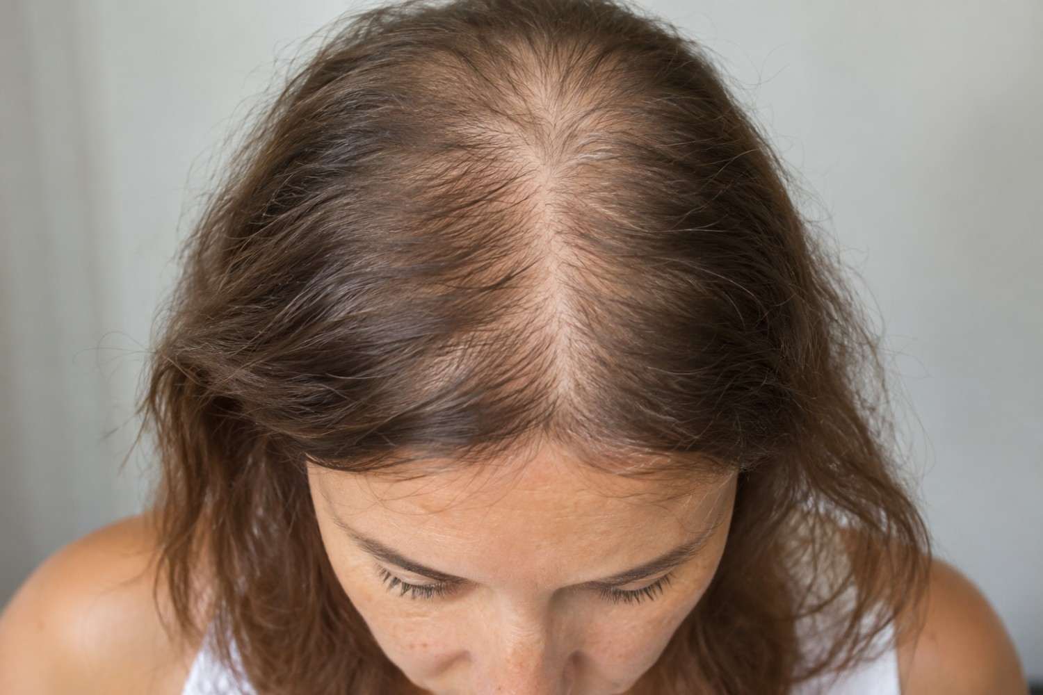 shedding and female pattern hair loss